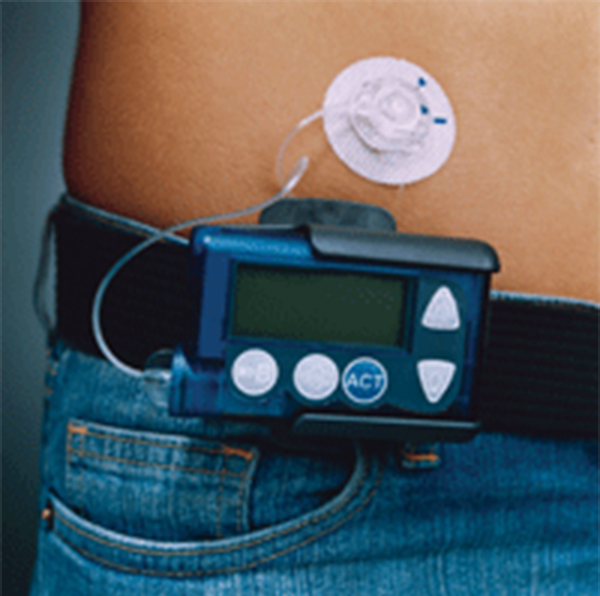 A Medtronic Insulin Pump Has Made a Huge Improvement in the Quality of John Robert Wiltgen's Life